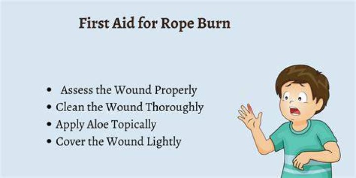 How do you make a rope burn feel better?