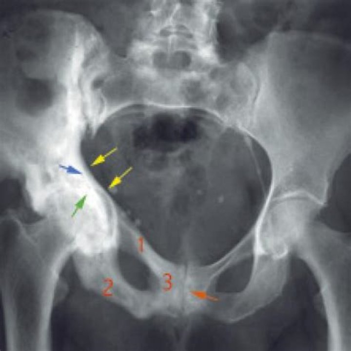 How do you tell if you have Paget's disease?