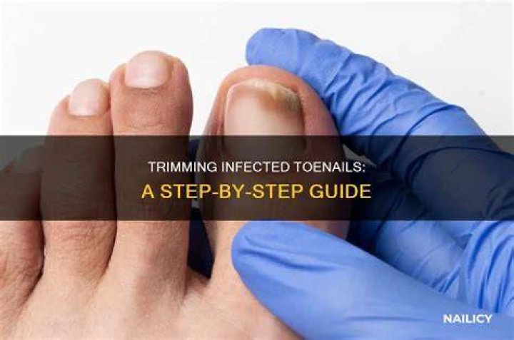 How do you trim toenail fungus?