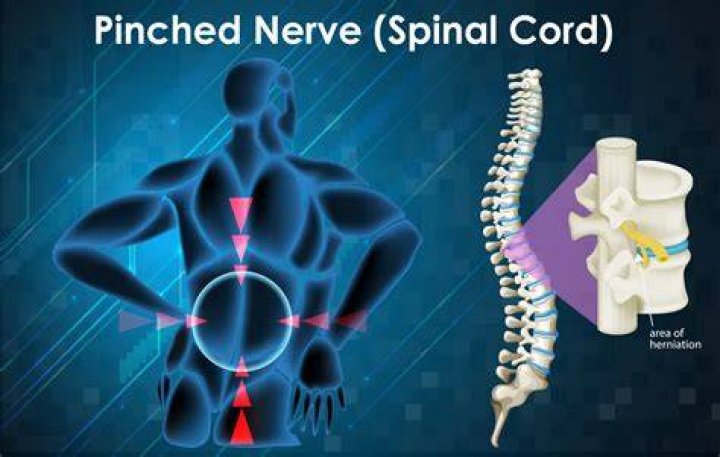 How do you Unpinch a nerve?