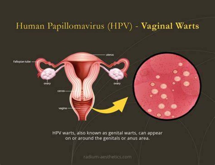 How does a woman get HPV?