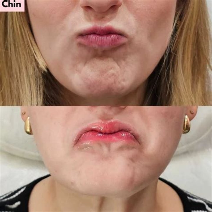 How long does chin Botox last?