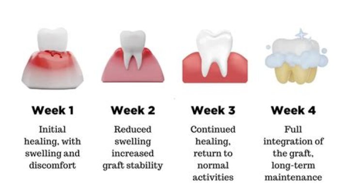 How long does it take a gum graft to adhere?