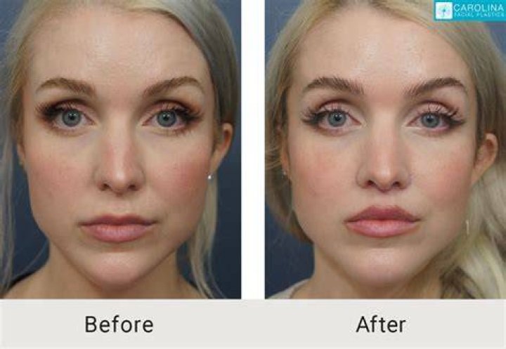 How much skin is removed in a lip lift?