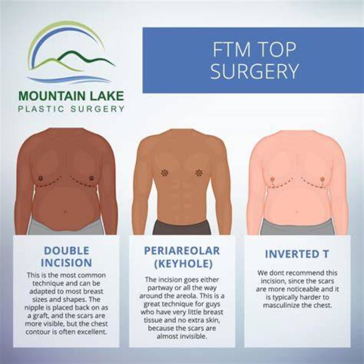 How old do you have to be to get top surgery?