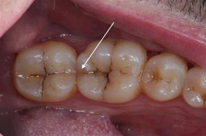 How serious is a cracked molar?