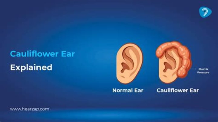 【How-to】How do you get cauliflower ear
