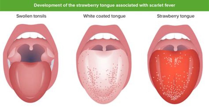 【How-to】How long does scarlet fever last
