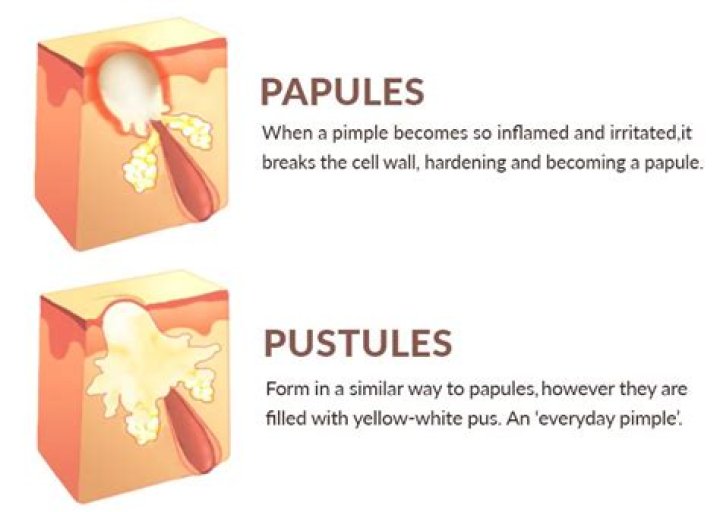 【How-to】How to get rid of papules