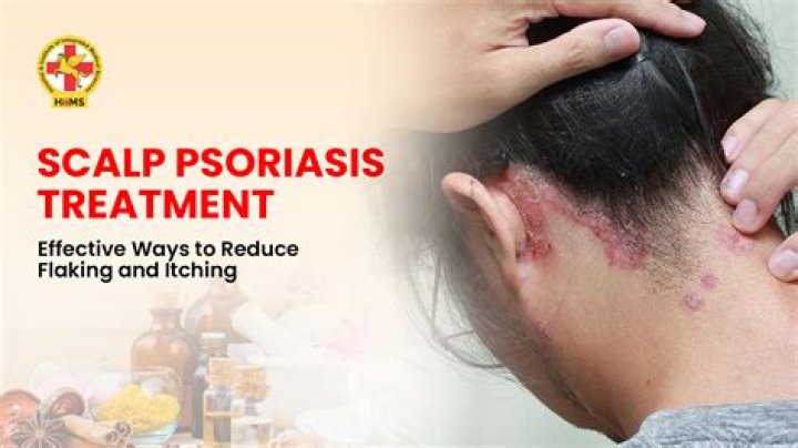 【How-to】How to get rid of scalp psoriasis