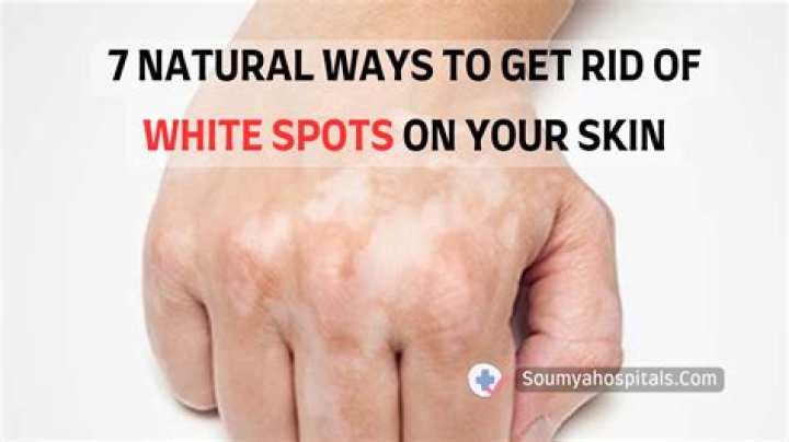 【How-to】How to get rid of white sunspots
