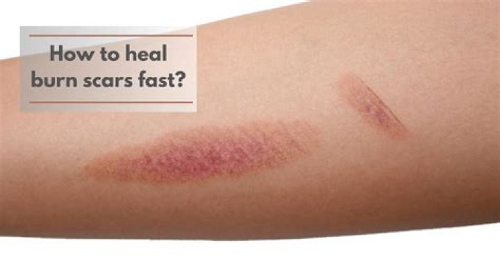 【How-to】How to make sunburn heal faster