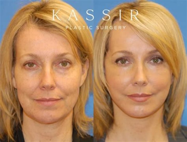 【How-to】What is the best age for otoplasty