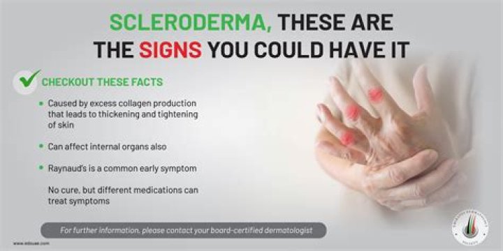 【How-to】What were your first symptoms of scleroderma