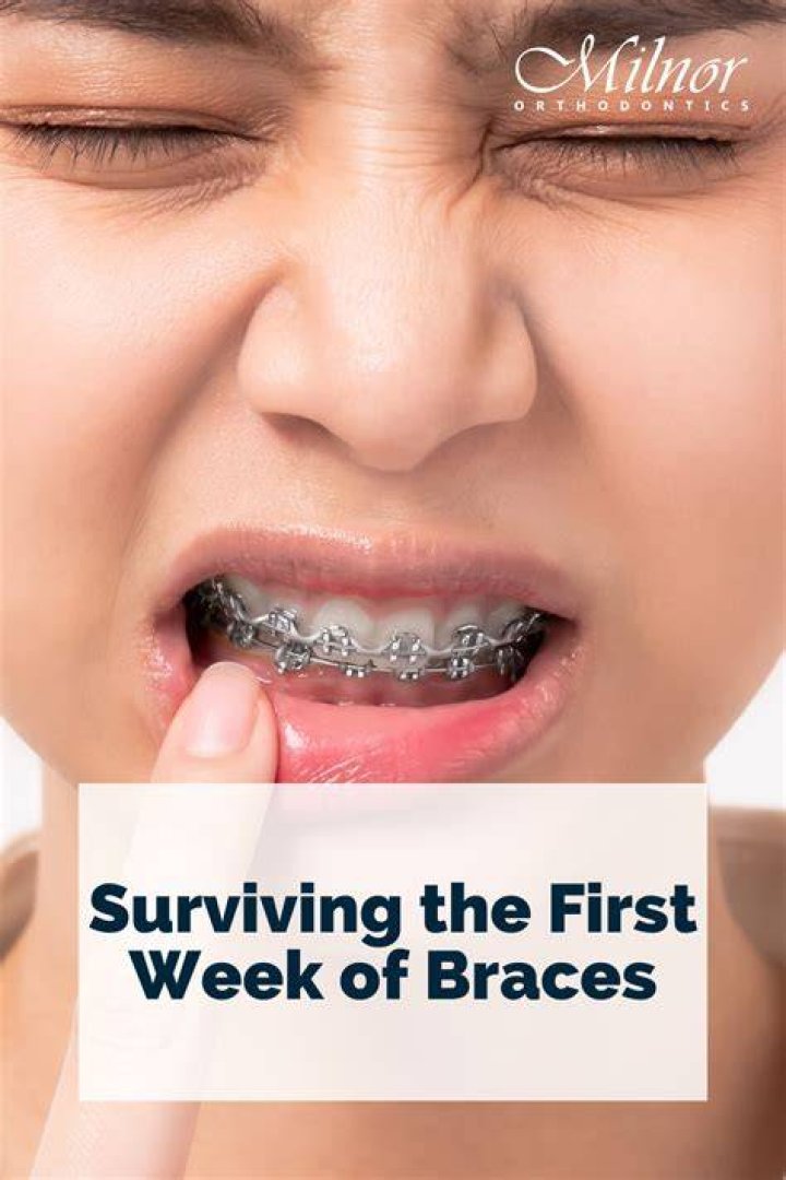 【How-to】Who came up with the idea of braces