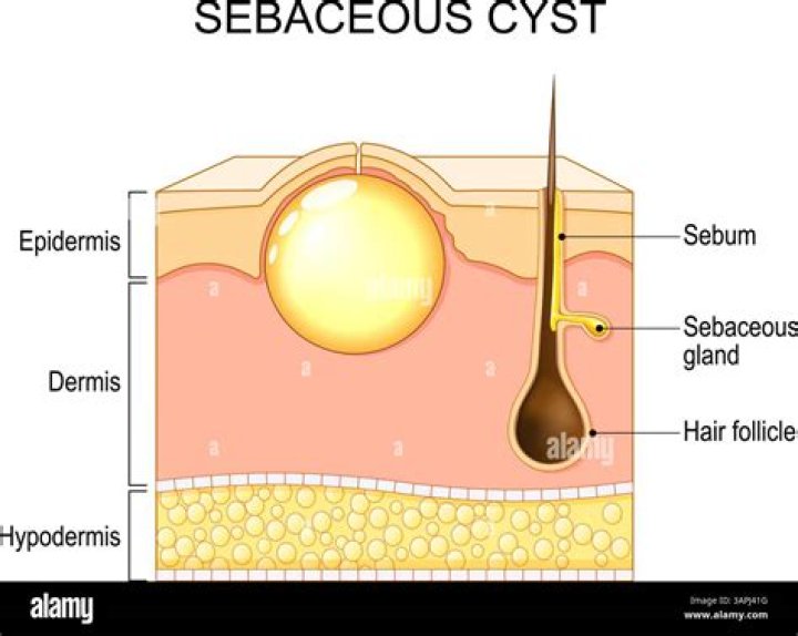 【How-to】Why do cysts smell - Howto.org
