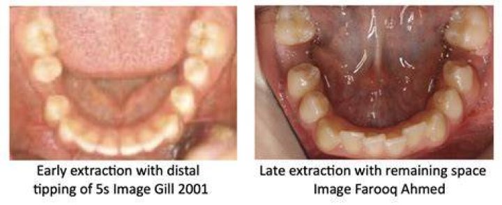 How were teeth removed in the old days?