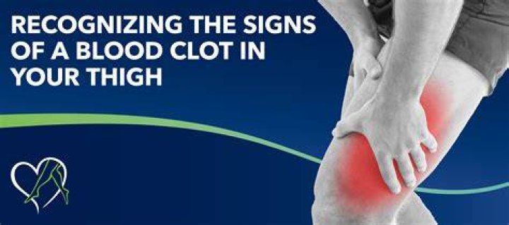 How would you know if you had a clot in your leg?
