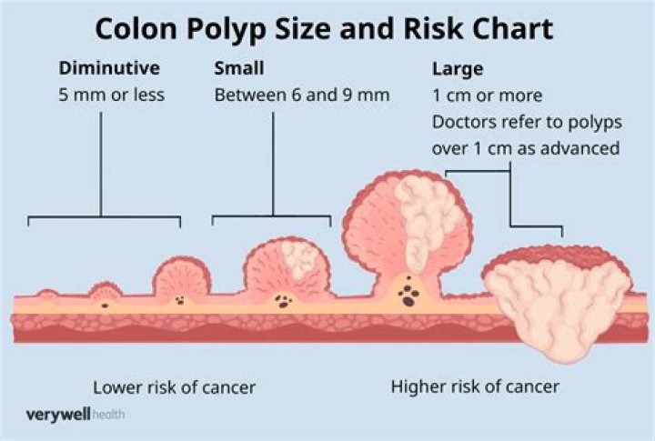 Is a 12 mm polyp considered large?