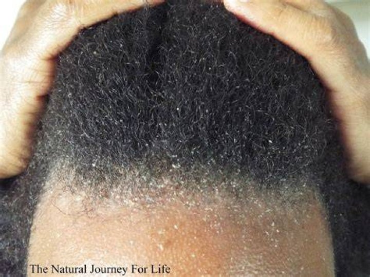 Is dandruff black?