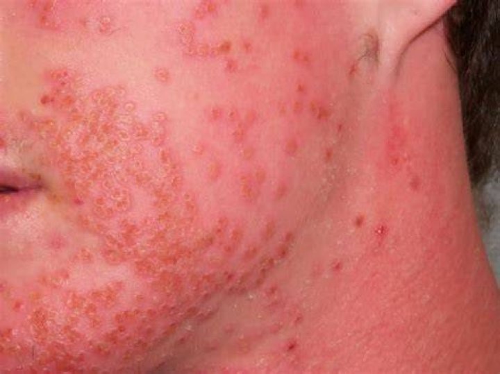 Is eczema bacterial or fungal?