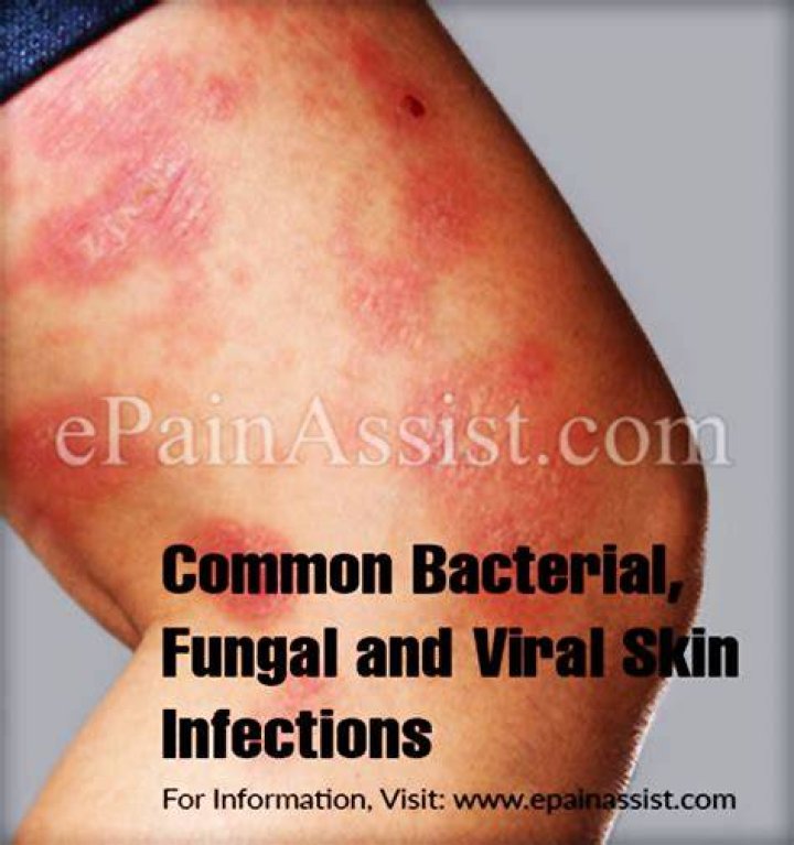 Is eczema fungal viral or bacterial?