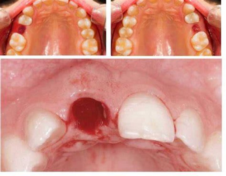 Is it normal to have a black hole after tooth extraction?