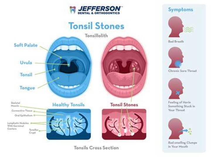 Is it OK to swallow tonsil stones?