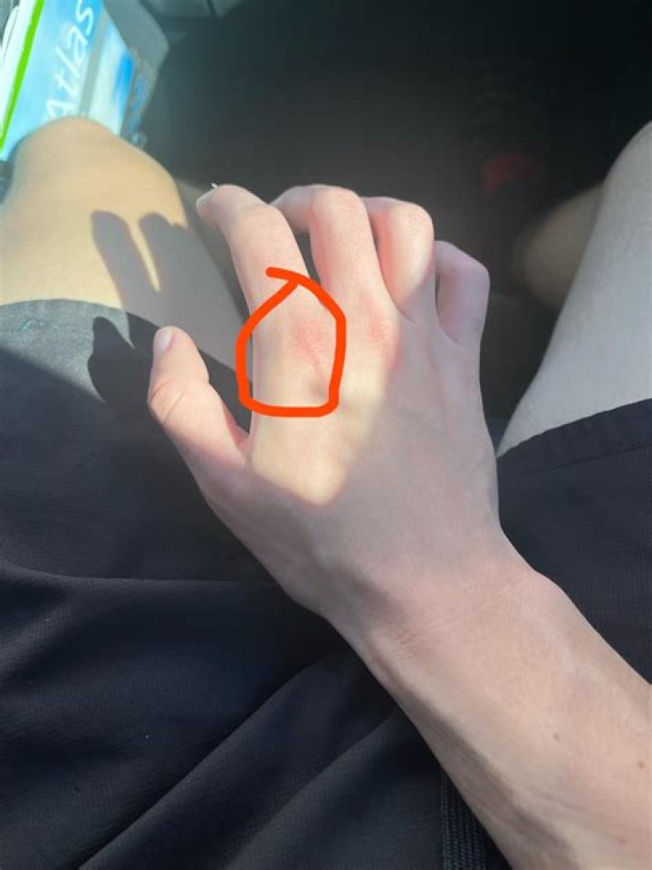 Is it possible to break a knuckle?