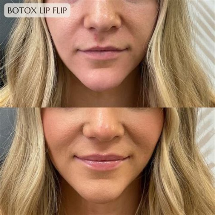 Is lip flipping Botox Worth It?