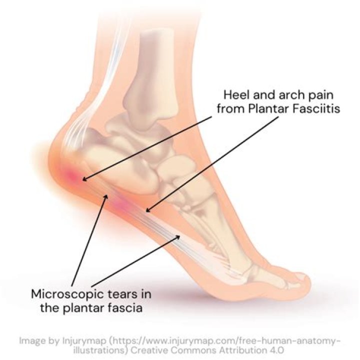 Is my plantar fasciitis healing?