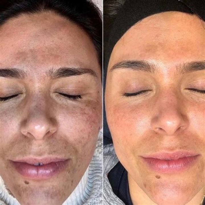 Is tea bad for your skin?