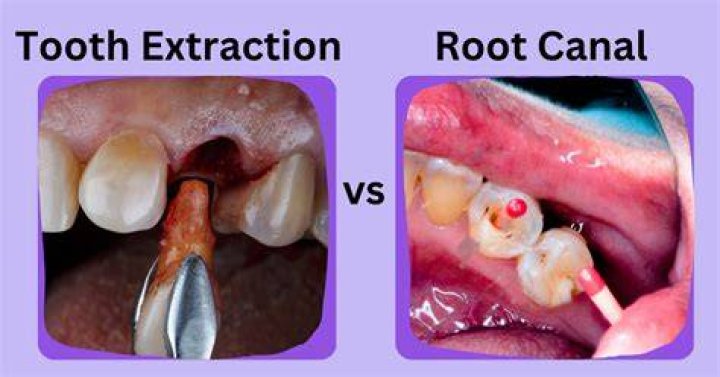 Is there an alternative to having a root canal?