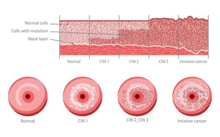 Should CIN 2 be treated?