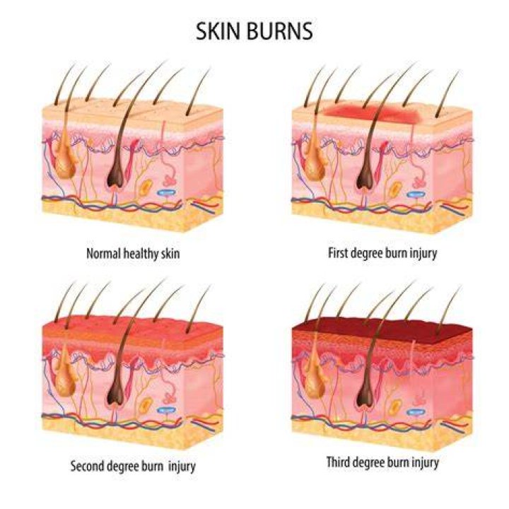 Should I cover my 2nd degree burn?