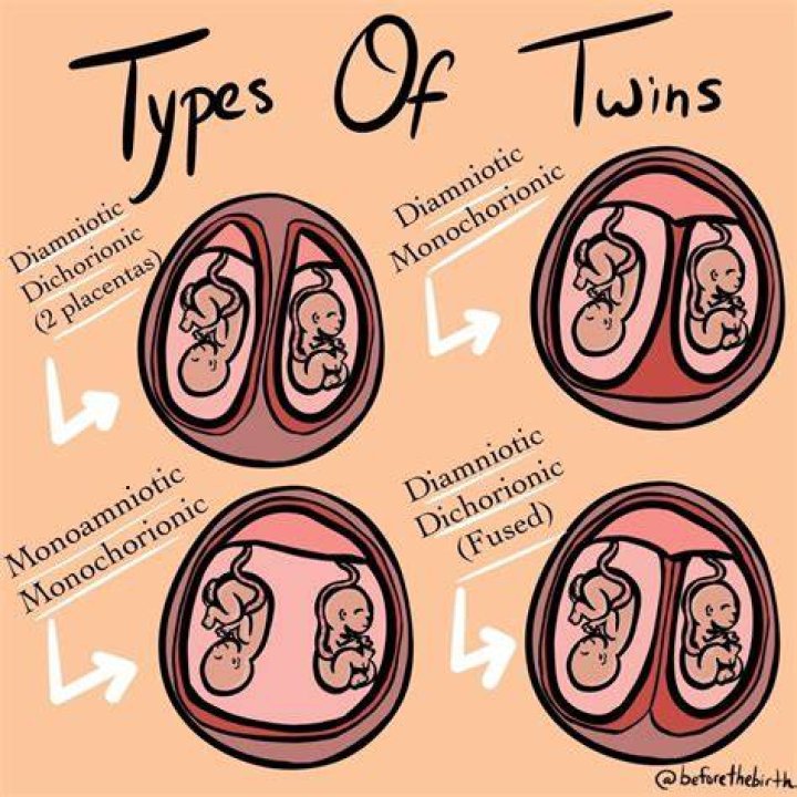 What are the 3 types of twins?