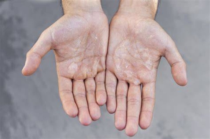 What causes static in hands?