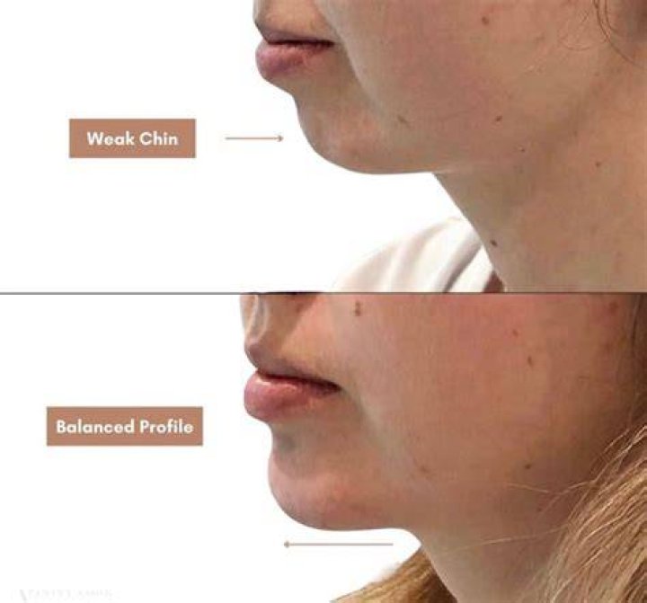 What causes weak chin?