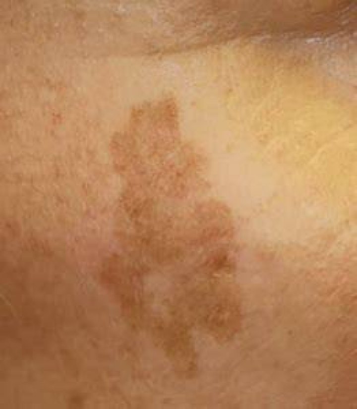 What do cancerous sun spots look like?
