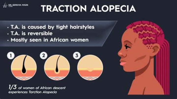 What do doctors prescribe for thinning hair?