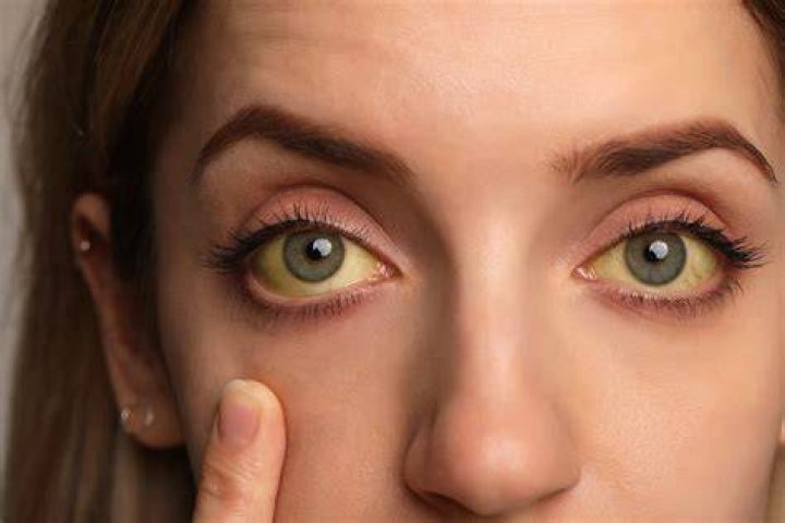What do liver problem eyes look like?