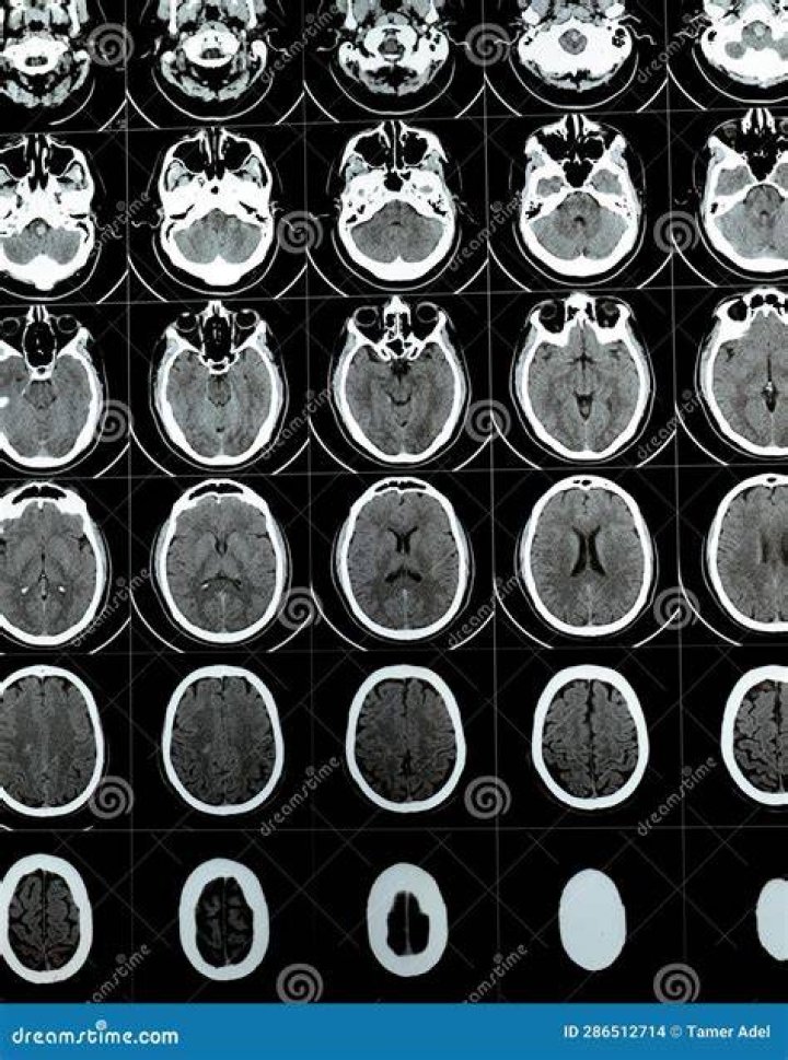 What does a CT scan show in the brain?