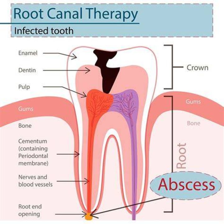 What does a tooth that needs a root canal feel like?