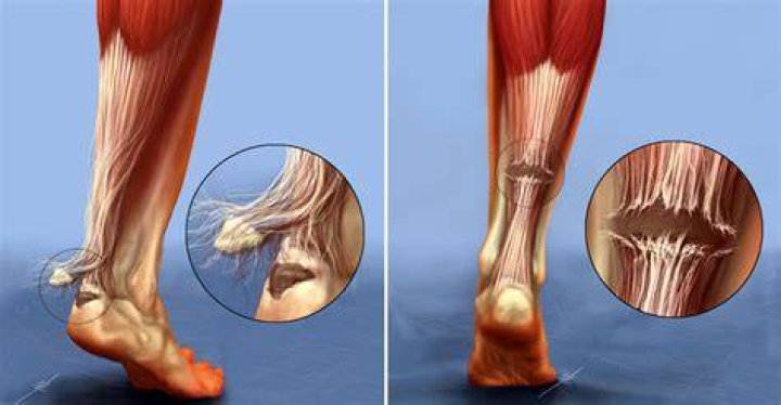 What does a torn tendon in your foot feel like?