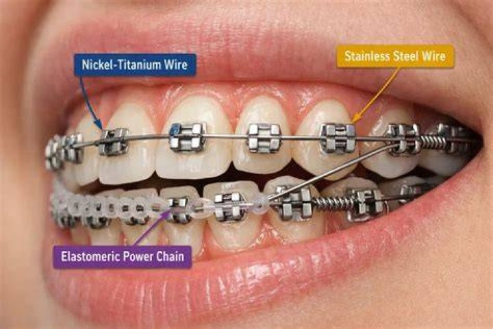 What does the final wire for braces mean?