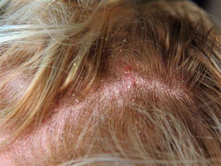 What does yeast look like in hair?