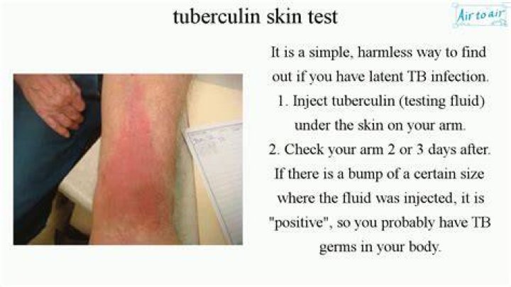 What happens if I accidentally scratch my TB test?
