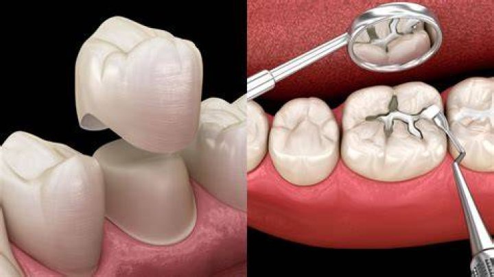 What happens if you don't crown a tooth?