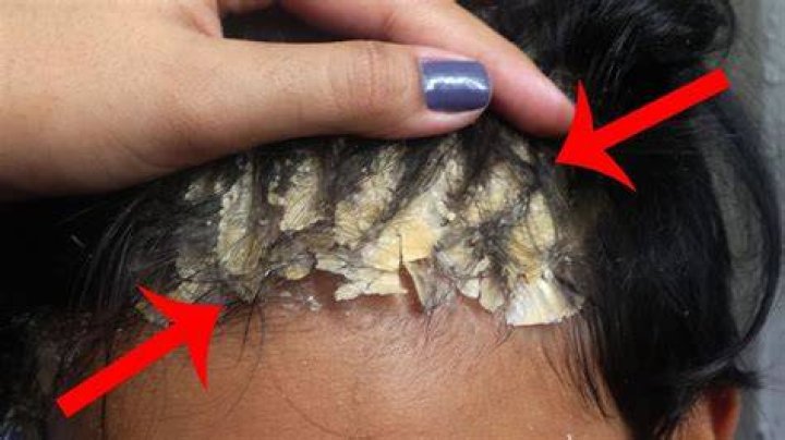 What happens if you scratch your head too hard?