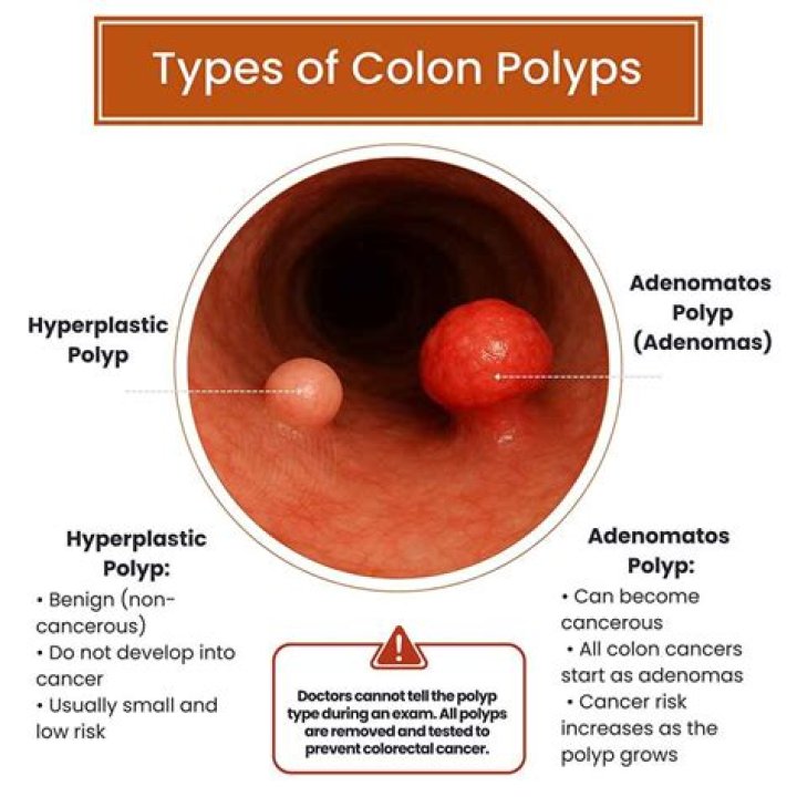 What happens when they find polyps during colonoscopy?